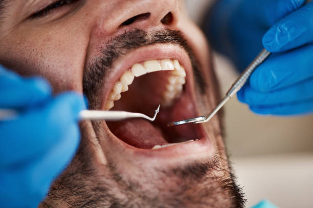 Best Emergency Wisdom Teeth Removal in Whitewater, KS